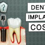 dental implants cost